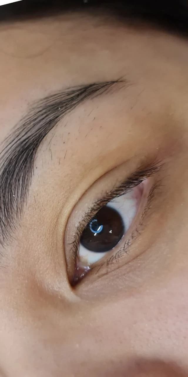 Oog voor de behandeling, met een lichte en onderbroken wimperrand